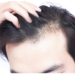 stop hair loss