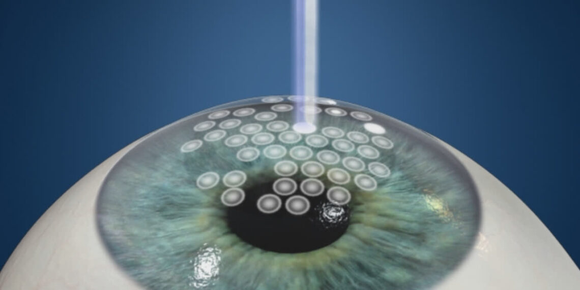 5 Things to Know About Photo-Refractive Keratectomy