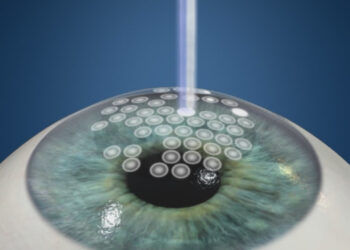 5 Things to Know About Photo-Refractive Keratectomy