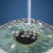 5 Things to Know About Photo-Refractive Keratectomy